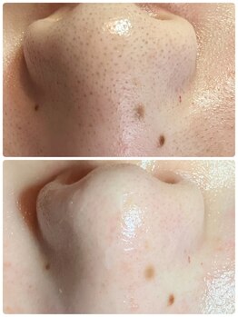 リンカ(Rinca)/感動の変化！！Before、after