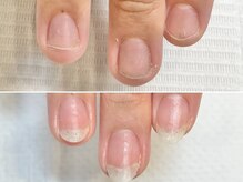 グラシュータン(gracieux temps)/深爪矯正