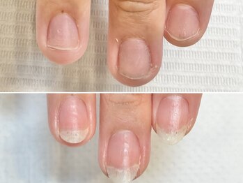 グラシュータン(gracieux temps)/深爪矯正