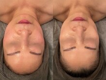 ポーデベロア(Peau des velours)/背中エステ/陶肌トリートメント