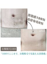 ティンクル サロン(Twinkle salon)/お腹周りの脱毛