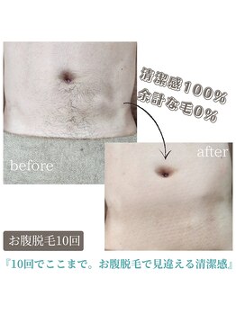 ティンクル サロン(Twinkle salon)/お腹脱毛でスッキリ印象