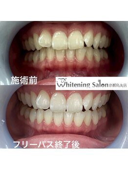 ホワイトニングサロン 京都烏丸店/ホワイトニング施術例