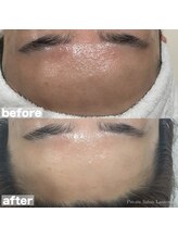 ランタン(Lantern)/ACトリートメント