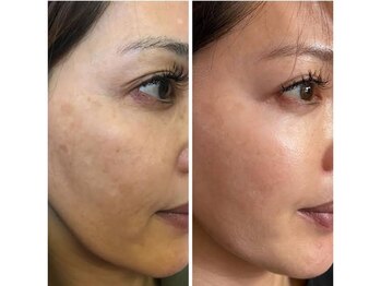 エキュレ ジャーニー トゥ マイ トータル ビューティー(equrer)/美白医薬部外品のスキンケアで