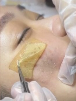 ザ リトリート(THE RETREAT)の写真/アメリカFDA認証の最新スポットシミケア☆【ホワイトラボ】導入！冬こそ徹底シミケア！