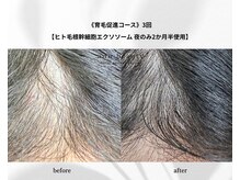 地域初！先進毛髪化学【育毛促進コース】ヒト毛根幹細胞エクソ