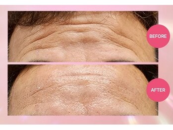 アトワ(A toi)/ プラズマフェイシャル3回