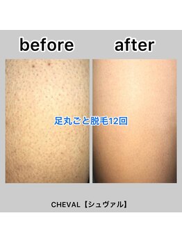 シュバル(CHEVAL)/足まるごと脱毛１２回施術後