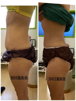 サロンドール(SalonDoll)/お腹