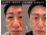 メンズ人気No1【肌質改善/ニキビケア/凹凸】ハーブピーリング5g