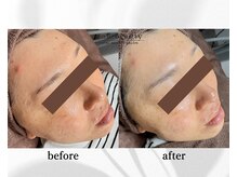 アン ビューティー(ann beauty)/施術1回【症例写真】30代