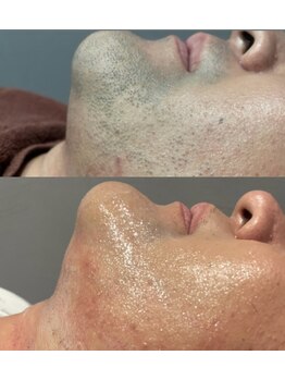 ヌック(NO-K)/ヒゲ脱毛