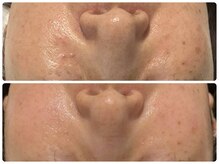 エフェクト 塚口店(effect)/Before After &nbsp;&nbsp;50代/8回目