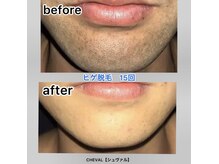 シュバル(CHEVAL)/ヒゲ脱毛（15回）施術後