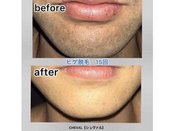 シュバル(CHEVAL)/ヒゲ脱毛（15回）施術後