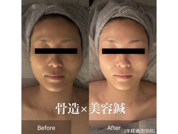 サロンリーナ 銀座店(SalonLena)/40代 1年経過ビフォーアフター