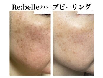 サラ/Re:belleハーブピーリング