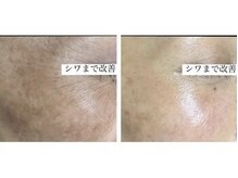 ラエッセ 目黒 白金台店(LAESSE)/毛穴・美白専門店 LAESSE 白金台