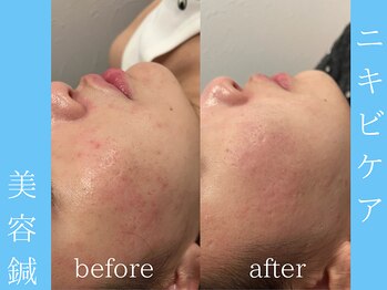 ビープラス(BEE PLUS)/頬ニキビケア