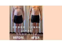 レパード/脂肪冷却で全身がスッキリ！