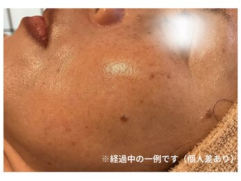 白の雫/肌印象の変化（施術経過の一例）