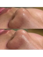 シンディー(CINDY)/毛穴洗浄