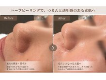 salon KARENA 【７/２０ NEW OPEN（予定）】 /毛穴消しゴム施術！