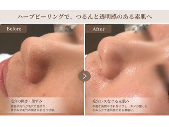 salon KARENA 【７/２０ NEW OPEN（予定）】 /毛穴消しゴム施術！