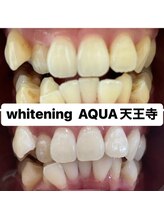アクア 天王寺店(AQUA)/セルフホワイトニング効果