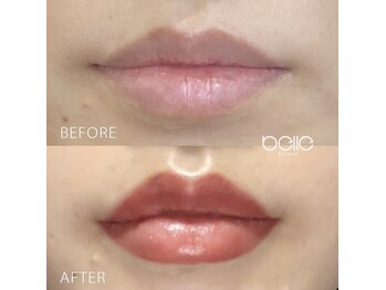 キノ(Kino)/渋谷ベル美容クリニックと提携