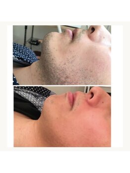 ムダ毛研究所 カンカ 銀座店(Kanka)/ヒゲ脱毛before →after2