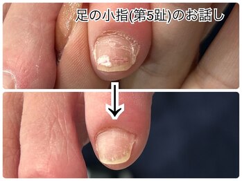 ネイルサロン イツキ(itsuki)/足の小指のお話し