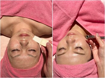 なちゅら(Nachula)の写真/フルーツ酸ピーリング×ダイヤモンドピーリングの2種類で古い角質を除去しくすみやニキビのお悩みを改善！
