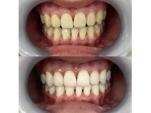 歯科提携ホワイトニングは圧倒的に効果があります！