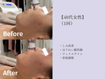 ベルペール(Belle perle)/【小顔】印象リフトフェイシャル