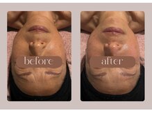 ステラ(STELLA)/マイナス◯歳も可能！？