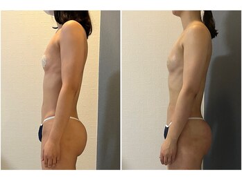 モア(moa)/バスト症例2回目