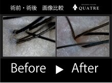 キャトル 離(QUATRE)/施術前後の変化