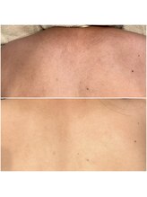 ハル(haru)/ビフォーアフター