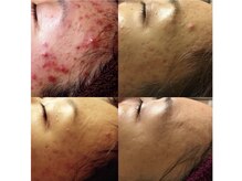 アンジェーム(angeame)/肌質改善おまかせください☆