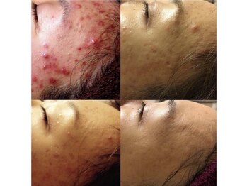 アンジェーム(angeame)/肌質改善おまかせください☆