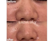 ラズリ(LazuLuLy)の雰囲気（ハイドラ毛穴洗浄1回の結果！毛穴が引き締まりツルスベ肌に感動）