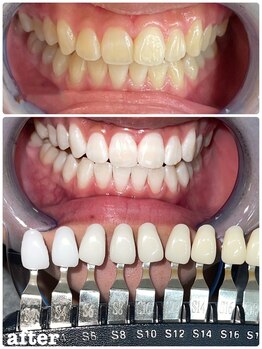 エクシアホワイトニング 札幌中島公園店/Before After［ホワイトニング］