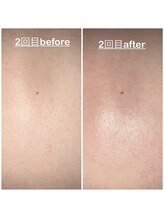 ミニョン(mignon)/まだ間に合う！背中！