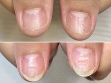 グラシュータン(gracieux temps)/【深爪矯正13000円】