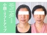【施術3回*小顔・リフトアップモニター】継続は美顔への第1歩!超お得に開始♪
