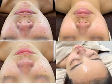 ニコレ(Nicore)/肌荒れ、赤ら顔のお悩み