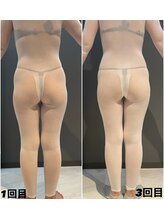 アルバ 広島店(ALBA)/エンダモロジー〈痩身ボディ〉