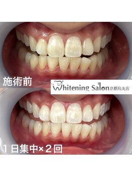 ホワイトニングサロン 京都烏丸店/ホワイトニング施術例